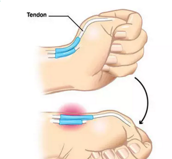 孕妇腱鞘炎怎么引起的 孕妇手腕手指腱鞘炎怎么办